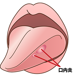 口内炎